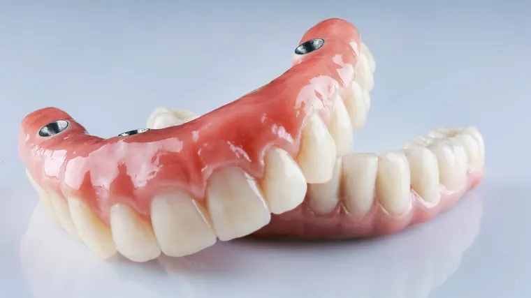 A full-arch All-on-4 prosthesis, a fixed set of teeth, showing the four connection points where it anchors onto dental implants, at Copper Sky Dental in Peoria, AZ